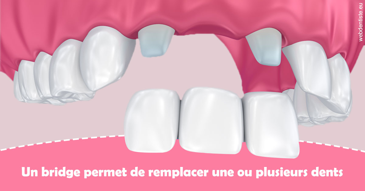 https://dr-jacques-wemaere.chirurgiens-dentistes.fr/Bridge remplacer dents 2