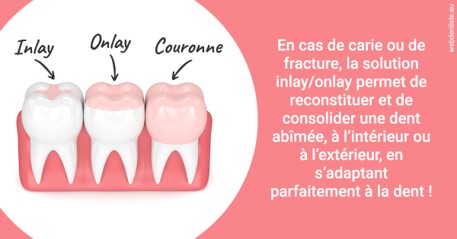 https://dr-jacques-wemaere.chirurgiens-dentistes.fr/L'INLAY ou l'ONLAY 2